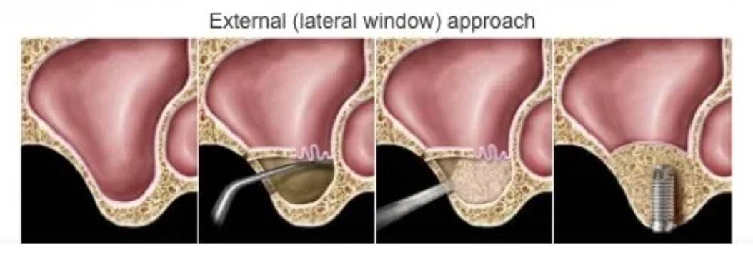 Open Sinus Lift